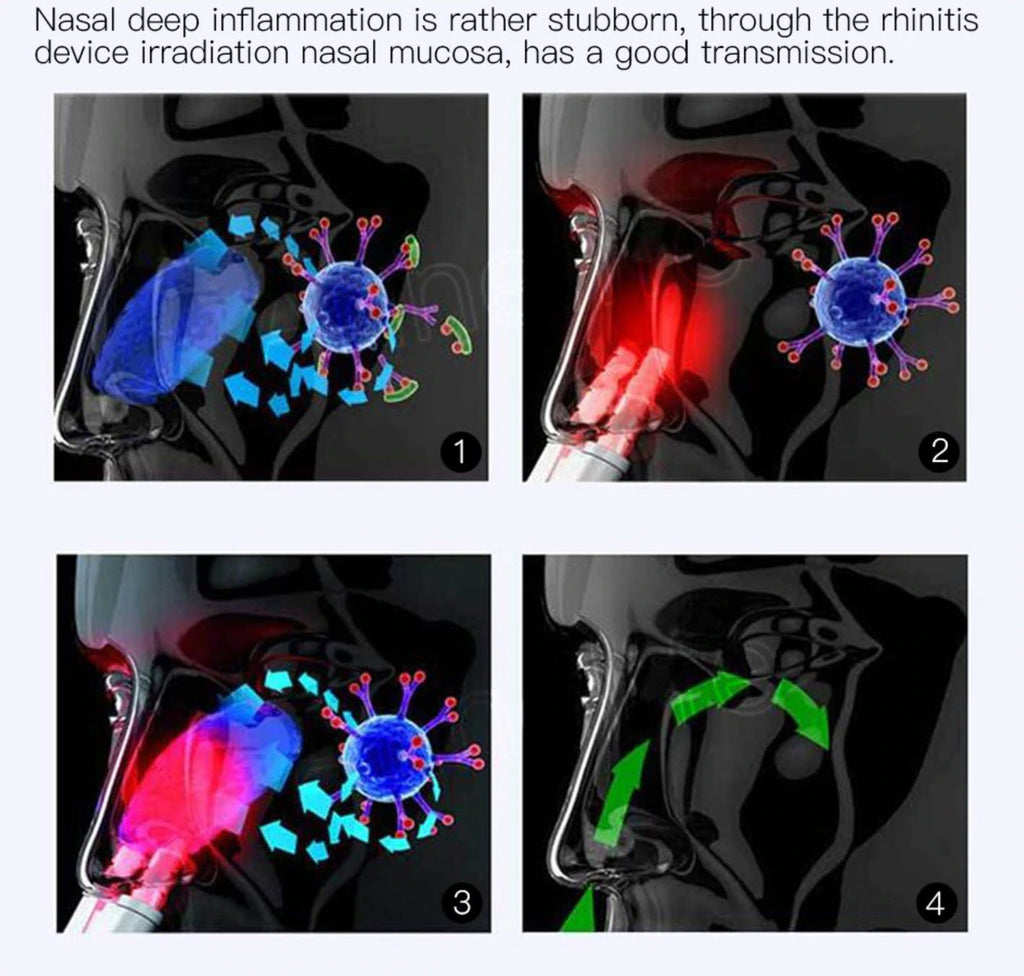 Infrared Rhinitis Therapy Device | Effective Relief for Allergies 